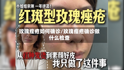 玫瑰痤疮如何确诊/玫瑰痤疮确诊做什么检查