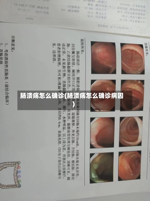 肠溃疡怎么确诊(肠溃疡怎么确诊病因)-第1张图片