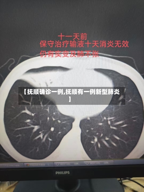 【抚顺确诊一例,抚顺有一例新型肺炎】