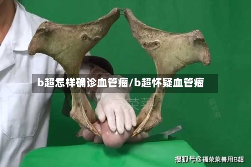 b超怎样确诊血管瘤/b超怀疑血管瘤