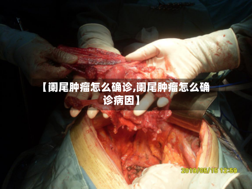 【阑尾肿瘤怎么确诊,阑尾肿瘤怎么确诊病因】